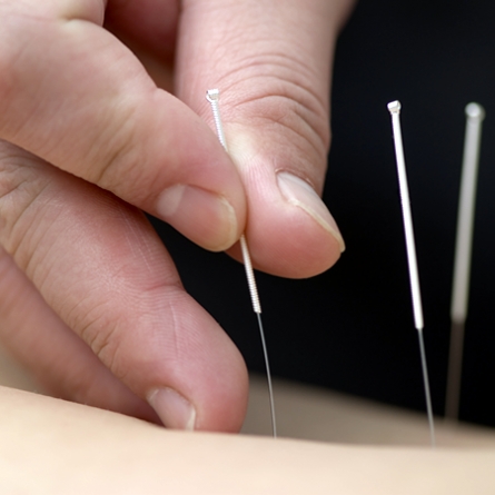 Acupuntura